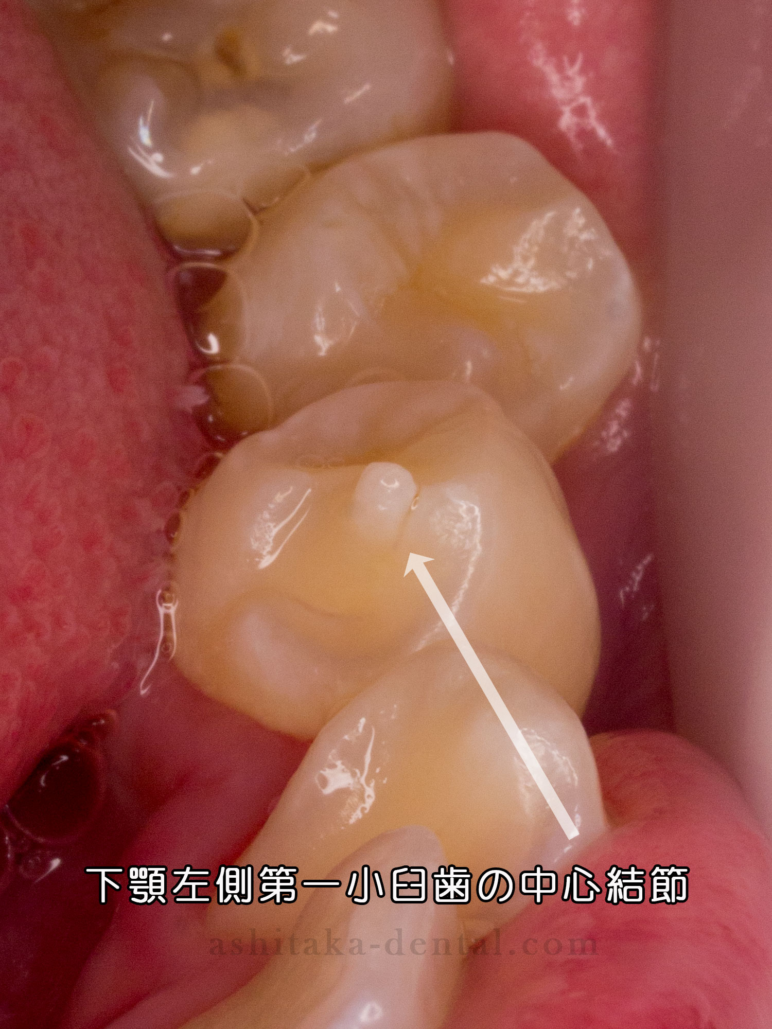 生えてきた大人の歯にツノのようなものがある 中心結節 あしたか歯科医院